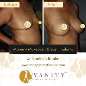 mommy-makeover-breast-implants-vanity-cosmetic-clinic-45-deg-right-side-view-case-1