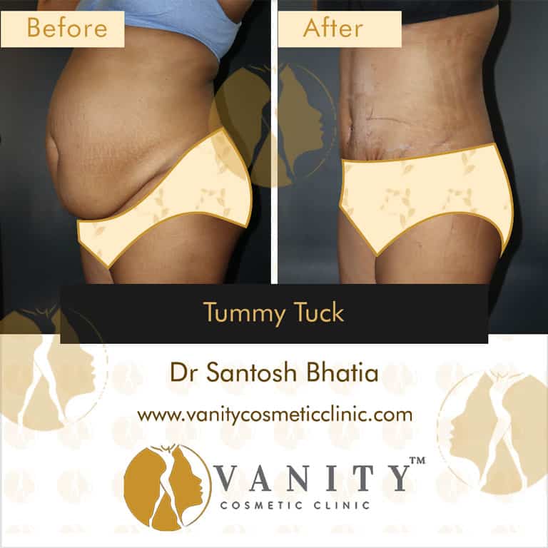 mommy-makeover-tummy-tuck-vanity-cosmetic-clinic-45-deg-left-side-view-5