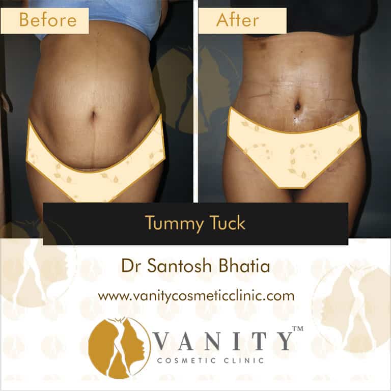 mommy-makeover-tummy-tuck-vanity-cosmetic-clinic-front-view-5