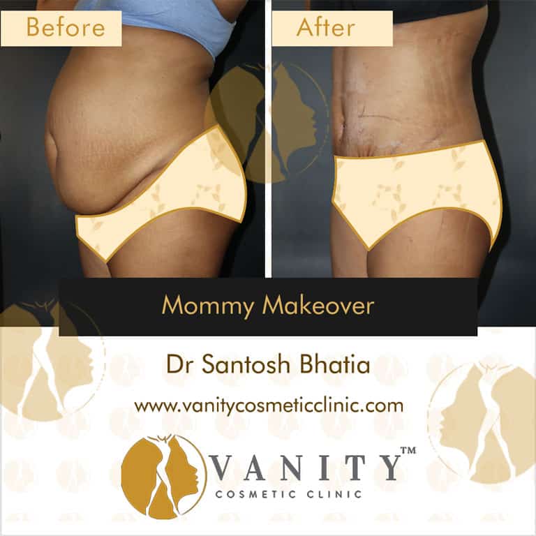 mommy-makeover-vanity-cosmetic-clinic-45-deg-left-side-view-5