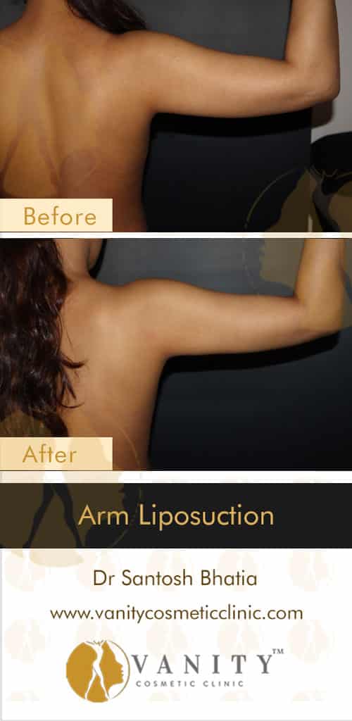 vcc-before-after-arm-liposuction-back-view