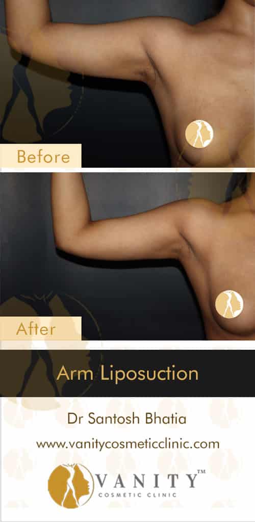vcc-before-after-arm-liposuction-front-view